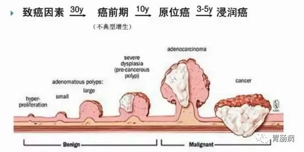 體檢查出腸息肉一定要切除！ 95%腸癌由它演變而來(lái)